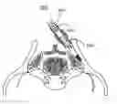 Fig. 01 - TOOLS FOR PERFORMING LESS INVASIVE ORTHOPEDIC JOINT PROCEDURES