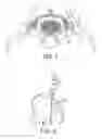 Fig. 02 - TOOLS FOR PERFORMING LESS INVASIVE ORTHOPEDIC JOINT PROCEDURES