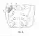 Fig. 03 - TOOLS FOR PERFORMING LESS INVASIVE ORTHOPEDIC JOINT PROCEDURES