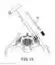 Fig. 11 - TOOLS FOR PERFORMING LESS INVASIVE ORTHOPEDIC JOINT PROCEDURES