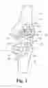 Fig. 02 - Low profile patient specific cutting blocks for a knee joint