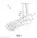 Fig. 02 - Systems and methods for installing an orthopedic implant