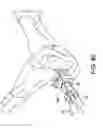 Fig. 62 - Systems and methods for installing an orthopedic implant