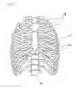 Fig. 02 - Medical device for pectus excavatum deformity correction surgery