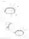 Fig. 04 - Medical device for pectus excavatum deformity correction surgery