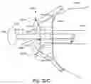Fig. 27 - System and method for reducing and stabilizing fractures in bone, subluxations, or dislocations