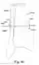 Fig. 42 - System and method for reducing and stabilizing fractures in bone, subluxations, or dislocations