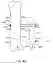 Fig. 44 - System and method for reducing and stabilizing fractures in bone, subluxations, or dislocations