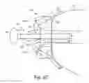Fig. 05 - Washer assembly for stabilizing a bone