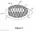 Fig. 03 - Cement-directing orthopedic implants