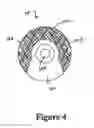 Fig. 05 - Cement-directing orthopedic implants