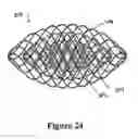 Fig. 25 - Cement-directing orthopedic implants