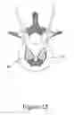 Fig. 26 - Cement-directing orthopedic implants