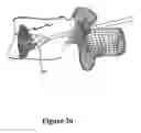 Fig. 27 - Cement-directing orthopedic implants
