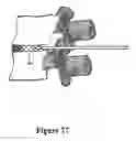 Fig. 28 - Cement-directing orthopedic implants