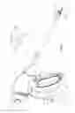 Fig. 02 - Electrosurgical instrument