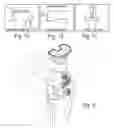 Fig. 07 - Method of designing orthopedic implants using in vivo data