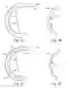 Fig. 17 - Method of designing orthopedic implants using in vivo data