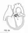 Fig. 04 - Storage assembly for prosthetic valve