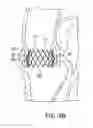 Fig. 05 - Storage assembly for prosthetic valve