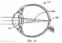 Fig. 03 - Single microstructure lens, systems and methods