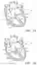 Fig. 02 - Prosthetic tissue valves and methods for anchoring same to cardiovascular structures