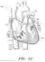Fig. 03 - Prosthetic tissue valves and methods for anchoring same to cardiovascular structures