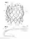 Fig. 03 - Suture deployment of prosthetic heart valve