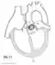 Fig. 07 - Suture deployment of prosthetic heart valve