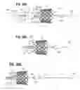Fig. 15 - Suture deployment of prosthetic heart valve