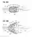 Fig. 17 - Suture deployment of prosthetic heart valve
