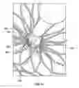 Fig. 27 - Suture deployment of prosthetic heart valve