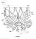 Fig. 31 - Suture deployment of prosthetic heart valve