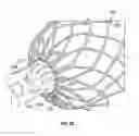 Fig. 34 - Suture deployment of prosthetic heart valve