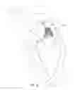 Fig. 13 - Mitral valve inversion prostheses