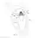 Fig. 14 - Mitral valve inversion prostheses