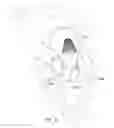 Fig. 15 - Mitral valve inversion prostheses
