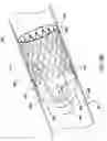 Fig. 14 - Venous valve prostheses