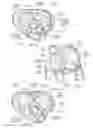 Fig. 03 - Devices, systems, and methods for reshaping a heart valve annulus