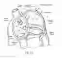 Fig. 07 - Devices, systems, and methods for reshaping a heart valve annulus