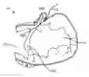 Fig. 01 - Treating dysfunctional cardiac tissue