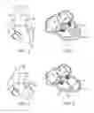 Fig. 02 - Treating dysfunctional cardiac tissue
