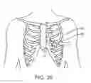 Fig. 16 - Treating dysfunctional cardiac tissue