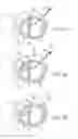 Fig. 17 - Treating dysfunctional cardiac tissue