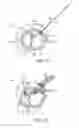 Fig. 24 - Treating dysfunctional cardiac tissue
