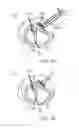 Fig. 25 - Treating dysfunctional cardiac tissue