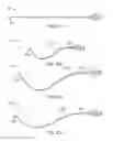Fig. 32 - Treating dysfunctional cardiac tissue