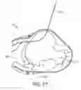 Fig. 37 - Treating dysfunctional cardiac tissue