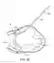 Fig. 40 - Treating dysfunctional cardiac tissue