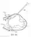 Fig. 41 - Treating dysfunctional cardiac tissue